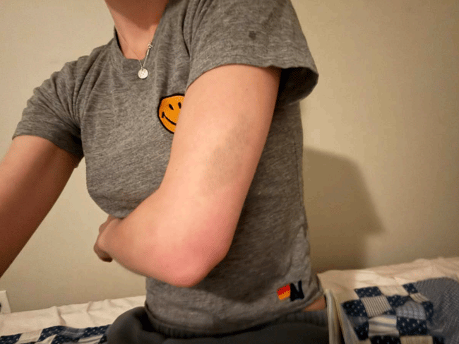 A photograph from Emily Moreno's court filings showing injuries she attributes to Rep. Max Miller. Her sworn affidavit attaches five photographs (Exhibits A-2 through A-6) that the motion says document injuries from the June 2024 incident in which she alleges Miller threw hot water on her and sprayed her with the sink hose. The Daily Mail's May 7 article also reported on a February 2026 custody exchange in which Moreno alleged Miller struck her, leaving bruises on her arm, elbow, and torso.